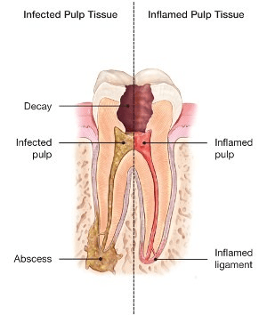 Root Canal In Kharadi