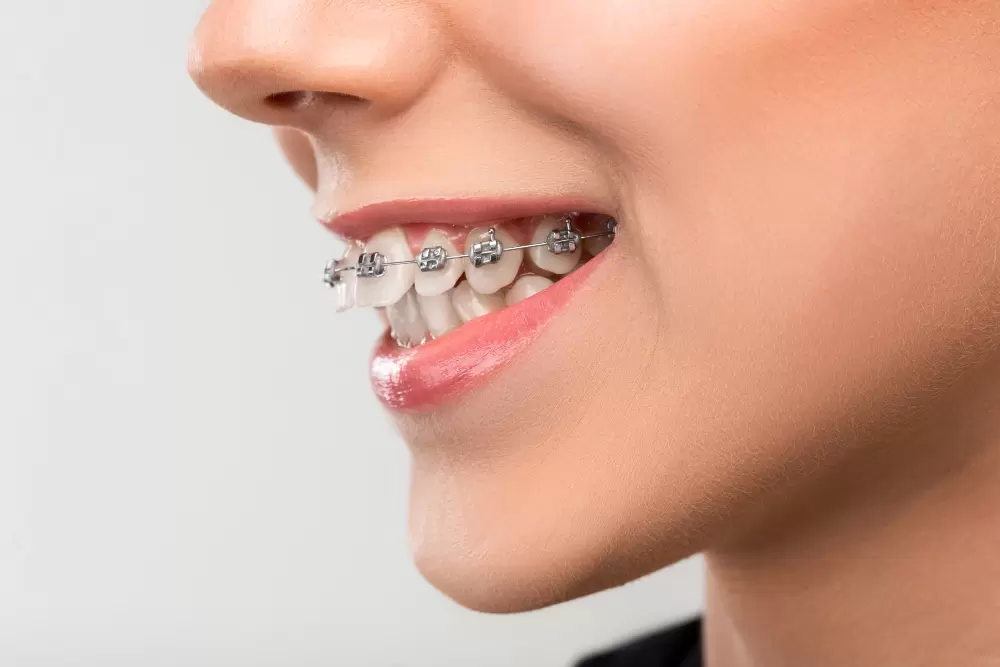 Dental Aligners In Bibwewadi