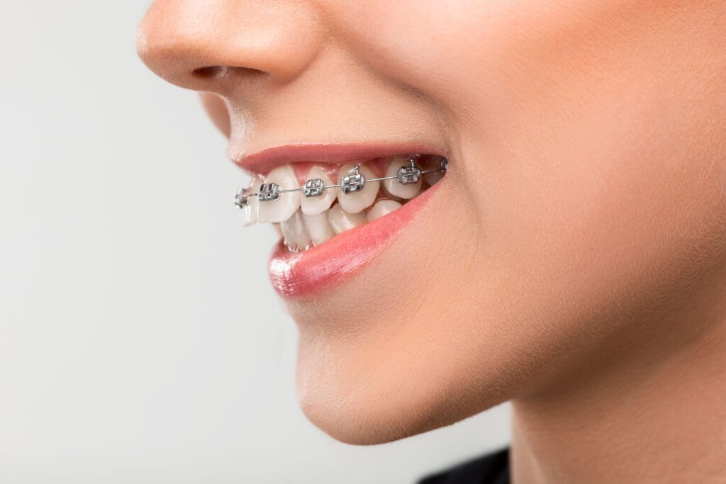 Braces in Pune